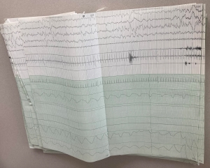 A paper copy of a sleep study showing lots of squiggly lines across the page over and over to track an entire night's sleep.