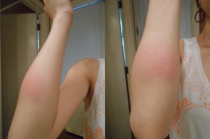 Swelling after bug bite.