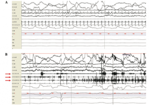 Figure A illustrates normal REM sleep while Figure B illustrates REM sleep without atonia. The three red arrows show the leads of the chin, leg, and arm. (Boeve et al, 2009)