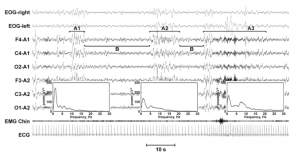This figure illustrates the different subtypes of CAP.
