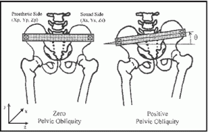 pelvic obliquity